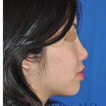 Ethnic Rhinoplasty Before & After Patient #6979