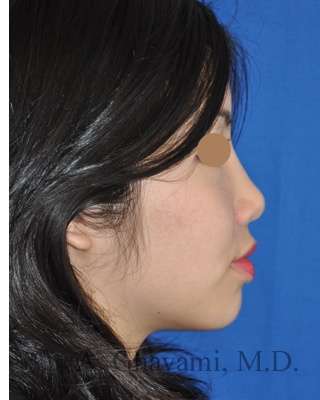 Ethnic Rhinoplasty Before & After Patient #6979