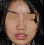 Ethnic Rhinoplasty Before & After Patient #6979