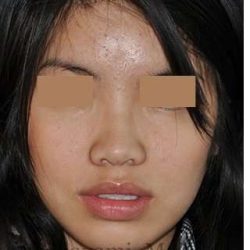 Ethnic Rhinoplasty Before & After Patient #6979