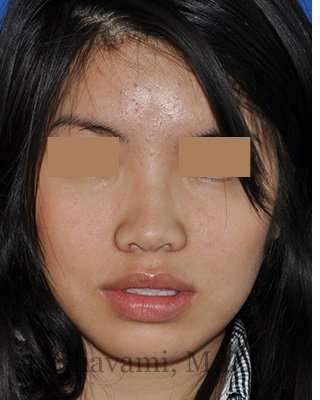 Ethnic Rhinoplasty Before & After Patient #6979