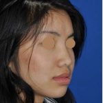 Ethnic Rhinoplasty Before & After Patient #6979