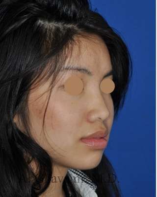 Ethnic Rhinoplasty Before & After Patient #6979
