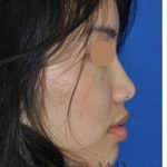 Ethnic Rhinoplasty Before & After Patient #6979