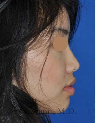 Ethnic Rhinoplasty Before & After Patient #6979