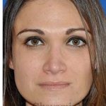 Revision Rhinoplasty Before & After Patient #6972
