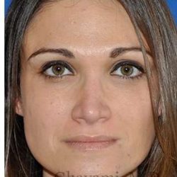 Revision Rhinoplasty Before & After Patient #6972