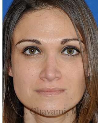 Revision Rhinoplasty Before & After Patient #6972