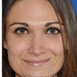 Revision Rhinoplasty Before & After Patient #6972