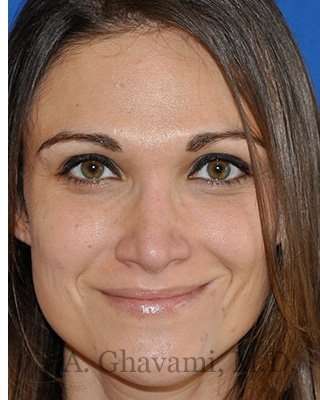 Revision Rhinoplasty Before & After Patient #6972