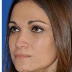 Revision Rhinoplasty Before & After Patient #6972