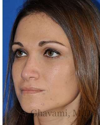 Revision Rhinoplasty Before & After Patient #6972