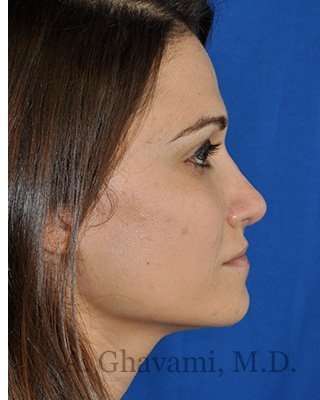 Revision Rhinoplasty Before & After Patient #6972