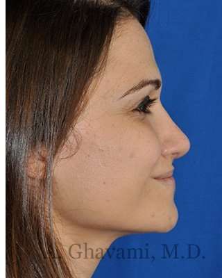 Revision Rhinoplasty Before & After Patient #6972