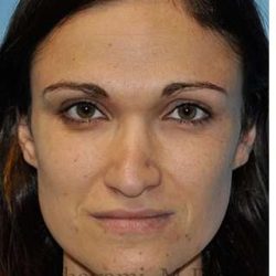 Revision Rhinoplasty Before & After Patient #6972