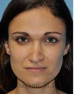 Revision Rhinoplasty Before & After Patient #6972