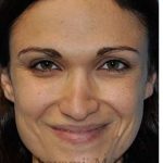 Revision Rhinoplasty Before & After Patient #6972