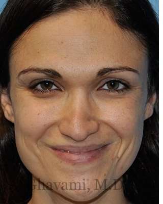 Revision Rhinoplasty Before & After Patient #6972