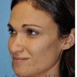 Revision Rhinoplasty Before & After Patient #6972