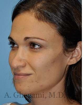Revision Rhinoplasty Before & After Patient #6972