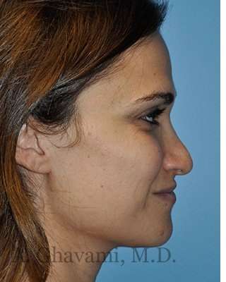 Revision Rhinoplasty Before & After Patient #6972