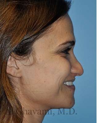 Revision Rhinoplasty Before & After Patient #6972