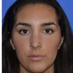 Ethnic Rhinoplasty Before & After Patient #6952