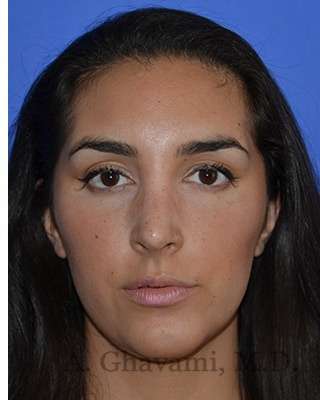 Ethnic Rhinoplasty Before & After Patient #6952