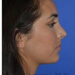 Ethnic Rhinoplasty Before & After Patient #6952