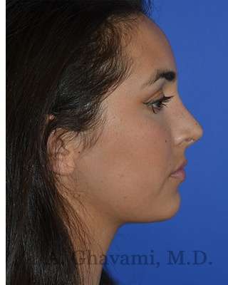 Ethnic Rhinoplasty Before & After Patient #6952