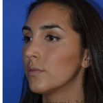 Ethnic Rhinoplasty Before & After Patient #6952
