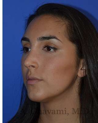 Ethnic Rhinoplasty Before & After Patient #6952