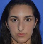 Ethnic Rhinoplasty Before & After Patient #6952