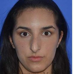 Ethnic Rhinoplasty Before & After Patient #6952