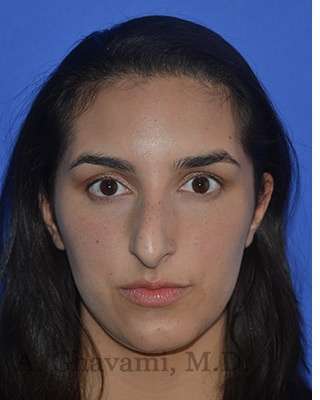 Ethnic Rhinoplasty Before & After Patient #6952