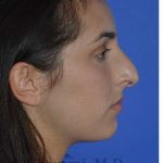 Ethnic Rhinoplasty Before & After Patient #6952
