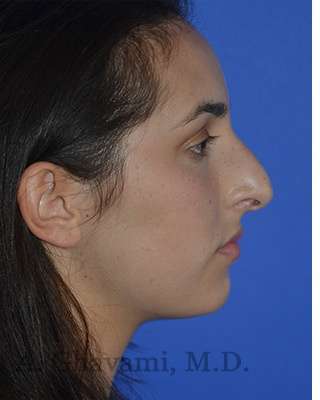 Ethnic Rhinoplasty Before & After Patient #6952