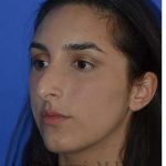 Ethnic Rhinoplasty Before & After Patient #6952