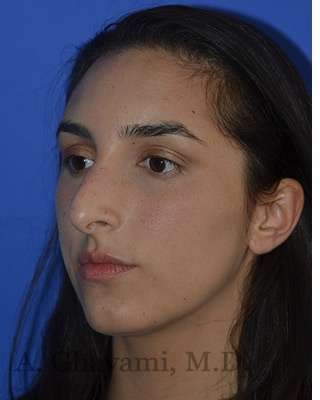 Ethnic Rhinoplasty Before & After Patient #6952