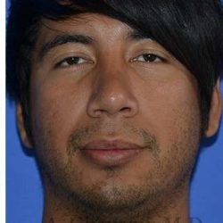 Male Rhinoplasty Before & After Patient #6945