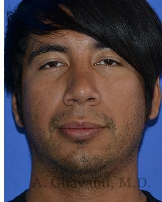 Male Rhinoplasty Before & After Patient #6945