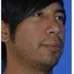 Male Rhinoplasty Before & After Patient #6945