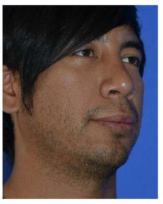 Male Rhinoplasty Before & After Patient #6945