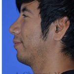 Male Rhinoplasty Before & After Patient #6945