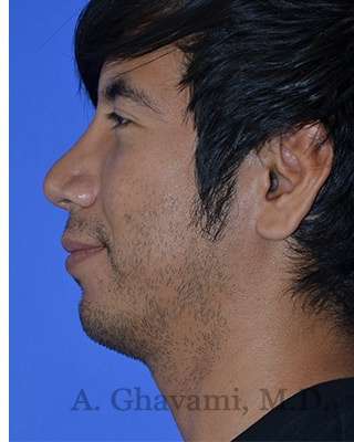 Male Rhinoplasty Before & After Patient #6945