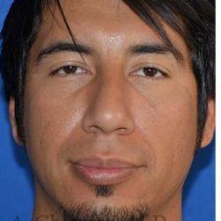 Male Rhinoplasty Before & After Patient #6945