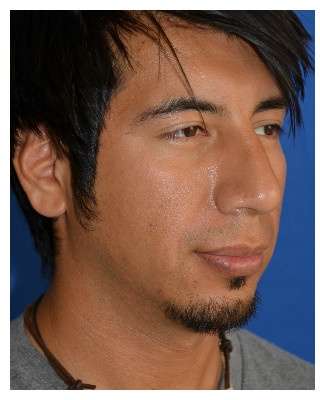 Male Rhinoplasty Before & After Patient #6945
