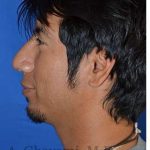 Male Rhinoplasty Before & After Patient #6945