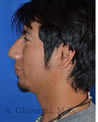 Male Rhinoplasty Before & After Patient #6945