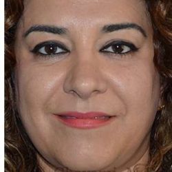 Ethnic Rhinoplasty Before & After Patient #6938